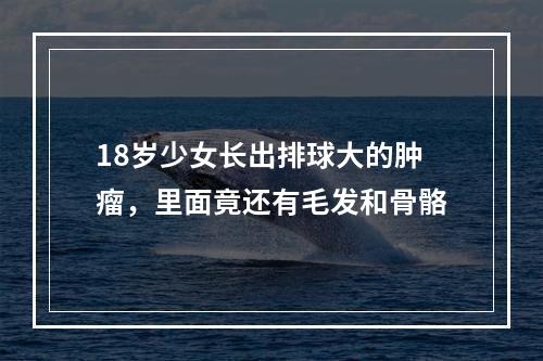 18岁少女长出排球大的肿瘤，里面竟还有毛发和骨骼