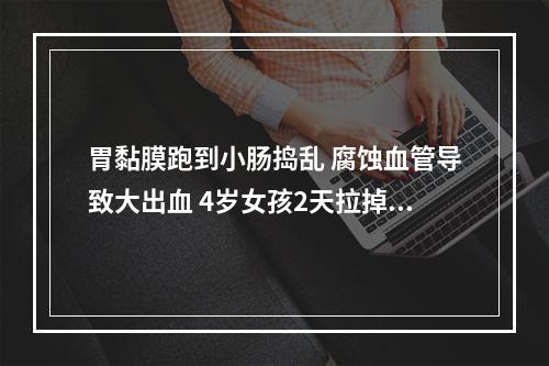 胃黏膜跑到小肠捣乱 腐蚀血管导致大出血 4岁女孩2天拉掉全身“一半血液”