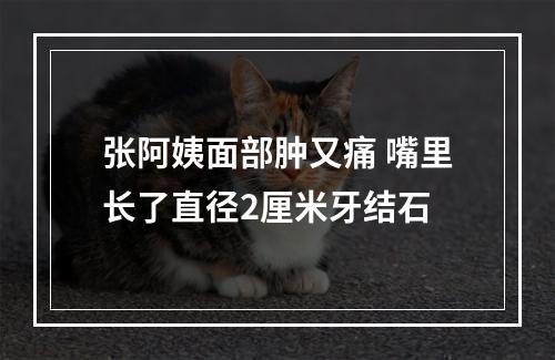 张阿姨面部肿又痛 嘴里长了直径2厘米牙结石