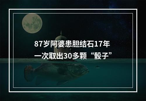 87岁阿婆患胆结石17年 一次取出30多颗“骰子”